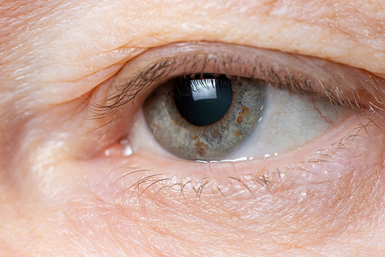  A patient suffering from lid ptosis