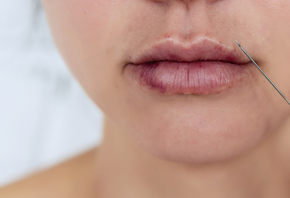 A patient suffers from vascular occlusion of the inferior labial artery