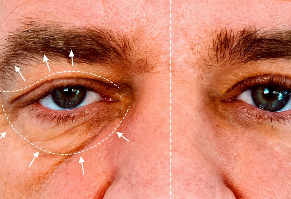 A man experiences ptosis on one side of his face after a bad Botox treatment