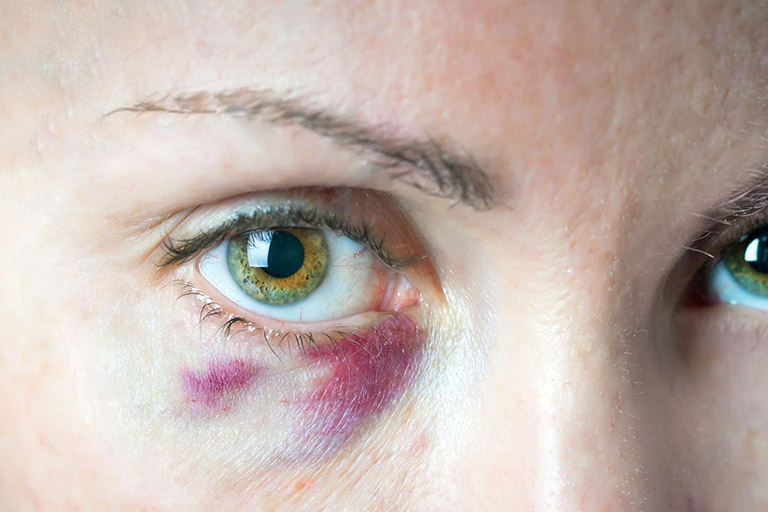  A patient with vascular occlusions shows purple discolouration under her eye