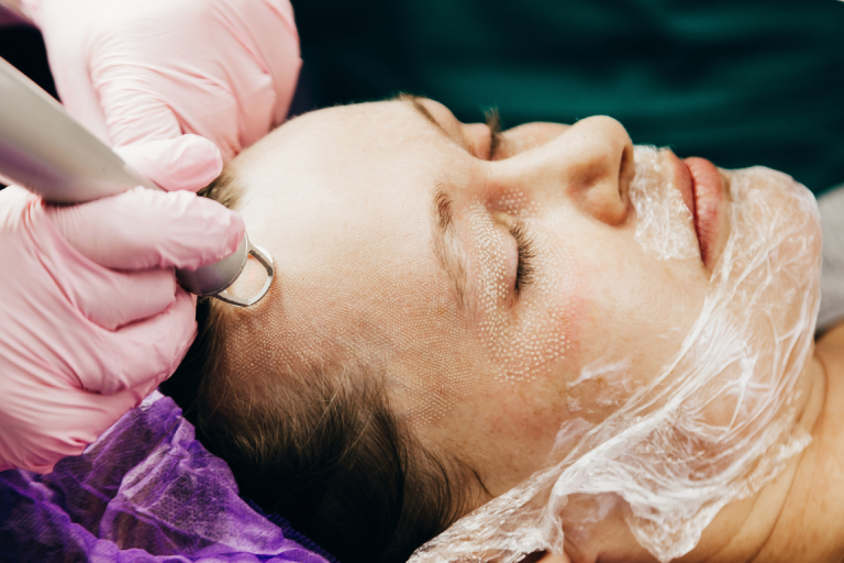 a patient receives a CO2 laser treatment